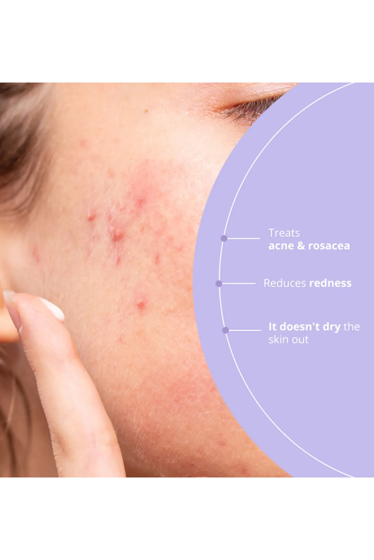 Azelaic Radiance Tratamiento facial