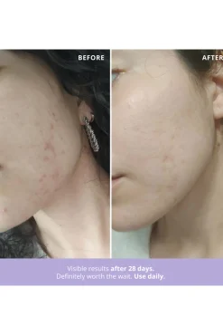 Azelaic Radiance Tratamiento facial